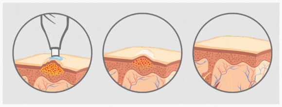 Shinchon Flat Warts May Spread If Simply Removed image 6