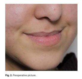 What Effects Can You Expect from Lip Rejuran? image 5