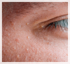 Shinchon Flat Warts May Spread If Simply Removed image 4