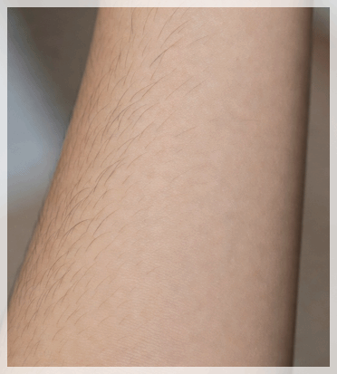 Hongdae Dermatology Hair Removal: Why Personalized Care Matters image 8