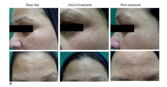 Wondering About the Lifting Effects of Shinchon Thermage? image 5