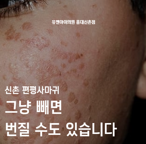 Shinchon Flat Warts May Spread If Simply Removed image 1