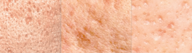 Sinchon Acne Scars: How They Are Treated by Type image 4