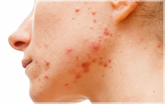Sinchon Acne Dermatology Clinic: Why Treatment Order Matters image 4