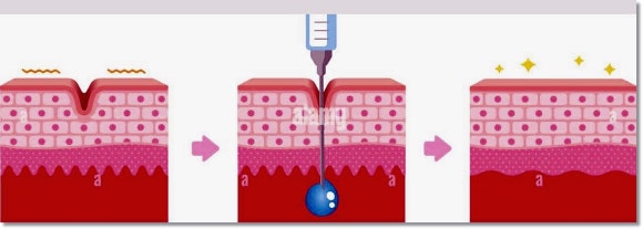 Worried About Side Effects of Skin Botox in Hongdae? image 2