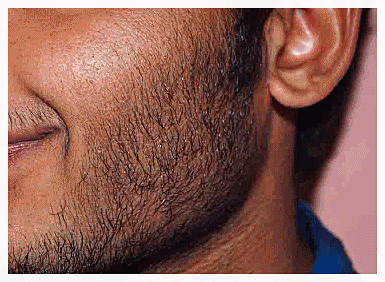 Sinchon Laser Hair Removal: Why a 5-Session Package May Not Be Enough image 6