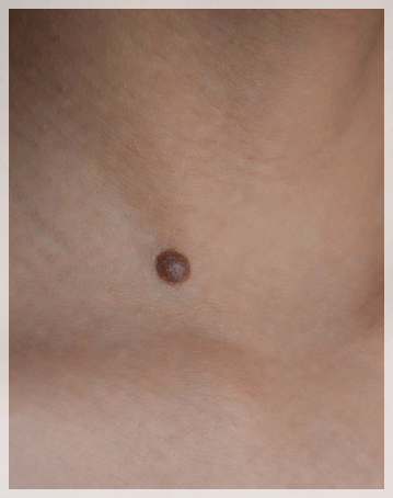 Hongdae Mole Removal: What to Know Before Having a Mole Removed image 5