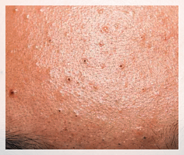 Sinchon Acne Dermatology Clinic: Why Treatment Order Matters image 3