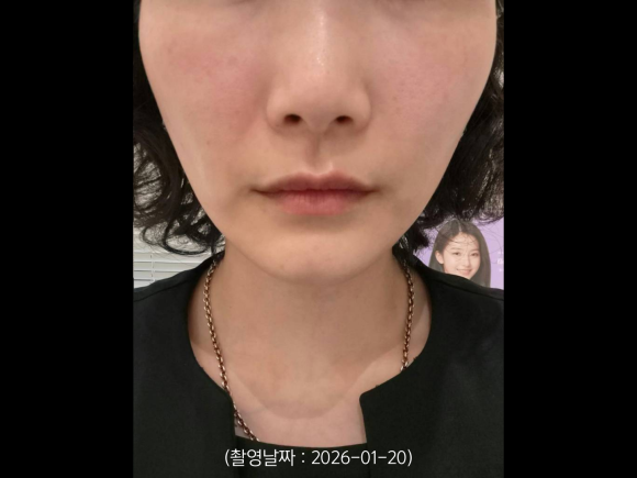 Case of Improving Nasolabial Folds and Sagging Deep Cheeks with Onda Lifting near Hongik Univ. Station image 3