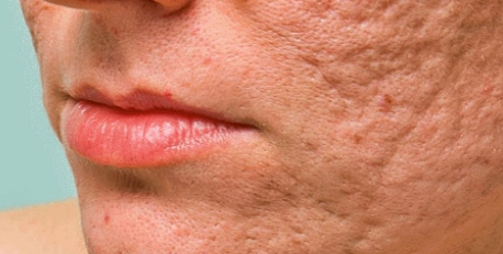 Sinchon Acne Scars: How They Are Treated by Type image 1