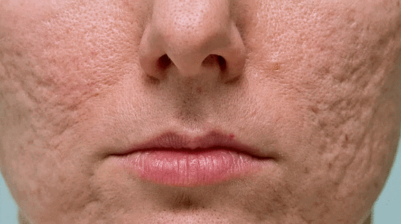 Hongdae Acne Dermatology: Can You Recover Smooth Skin Without Scarring? image 1