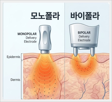 포텐자 다이아리프팅 다른 고주파 리프팅과 어떻게 다를까? 관련 이미지 2
