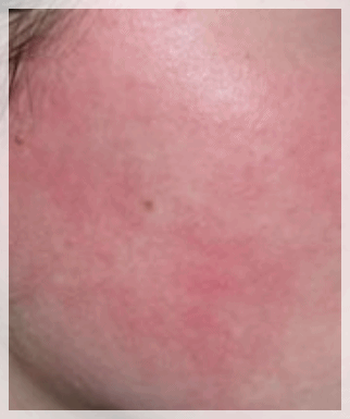 Hapjeong Station Dermatology Clinic: The Right Treatment for Your Skin Is Different for Everyone image 7