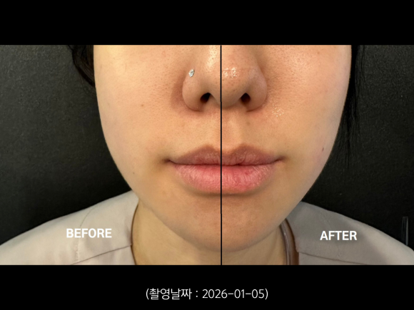 A Case of Improving a Round Jawline with the Tentriple Lift at Sinchon image 4