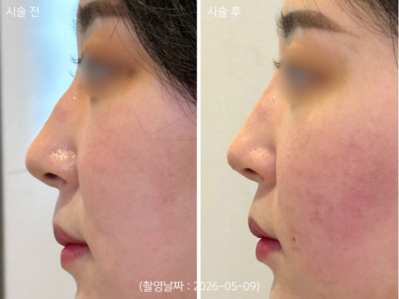 A Case of Correcting a Hump Nose with HiCo Thread Lifting in Hongdae image 5