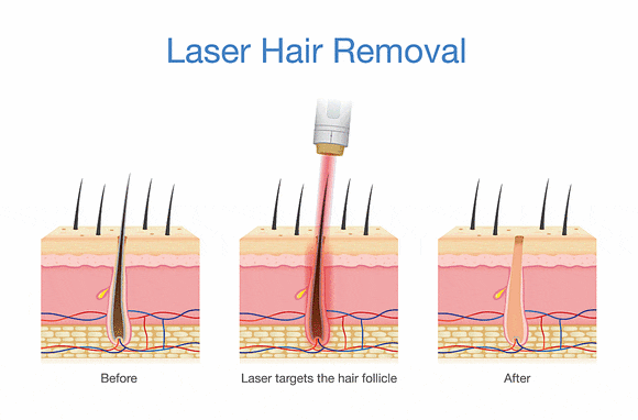 Frequently Asked Questions During a Shinchon Underarm Hair Removal Consultation: Number of Sessions and Pain, Organized image 2