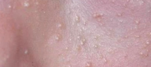 Shinchon Milia: If You’re Curious About What Makes a Good Clinic image 1