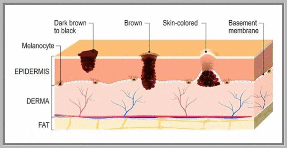 Sinchon Mole Removal: What to Check Before Price or Reviews image 3