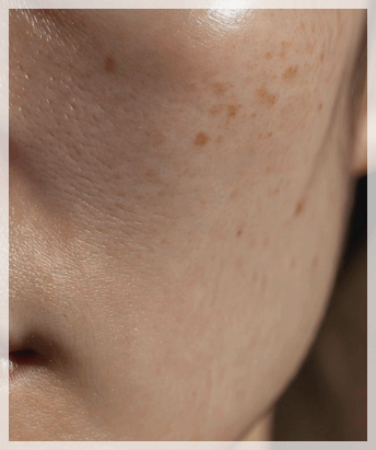 Sinchon Pico Toning: What to Check Before Considering Its Effects image 9