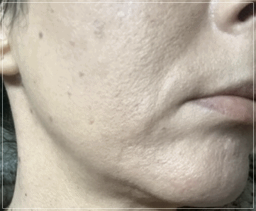 Sinchon Rejuran: Effects? Pain? Frequency? I’ll Tell You Everything. image 1