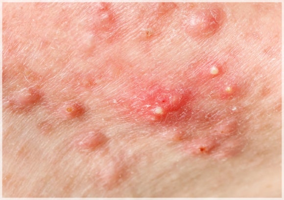 Potenza and Exosome Combination: What Skin Is It Effective For? image 6