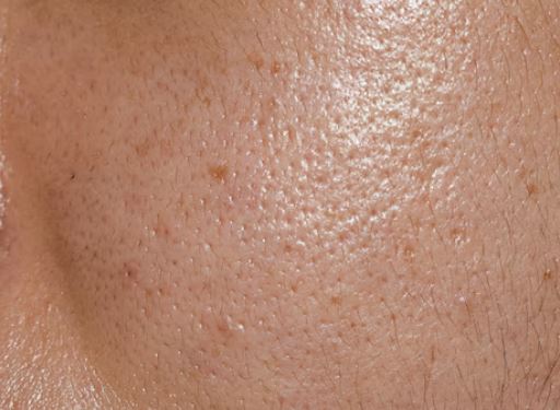 홍대 리쥬란힐러 효과, 통증, 후기는? 관련 이미지 1