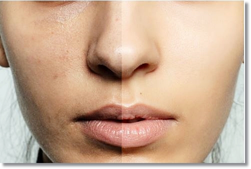 Must-Read If You’re Concerned About Melasma and Dark Spots: Pico Toning in Hongdae image 2