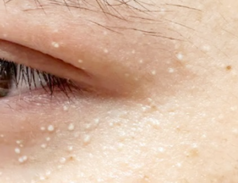 Shinchon Milia: If You’re Curious About What Makes a Good Clinic image 2