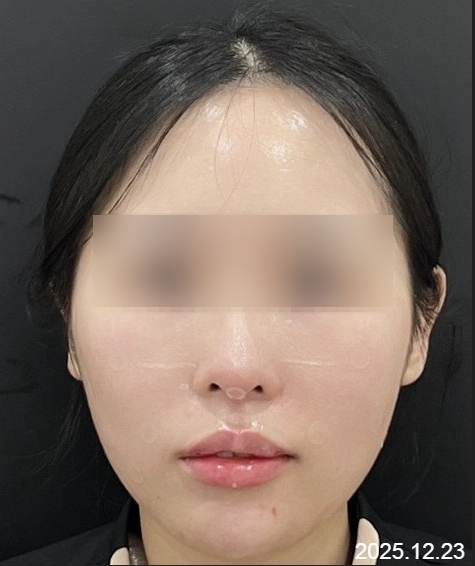 홍대 풀페이스 필러 시술 사례 - 눈 밑, 앞볼, 옆볼, 입술, 턱 필러 관련 이미지 2