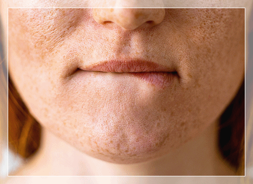 3 Things You Must Check for a Good Lip Filler Clinic in Hongdae image 4