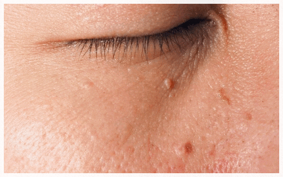 Why Flat Warts in Sinchon Keep Spreading to the Surrounding Area image 3
