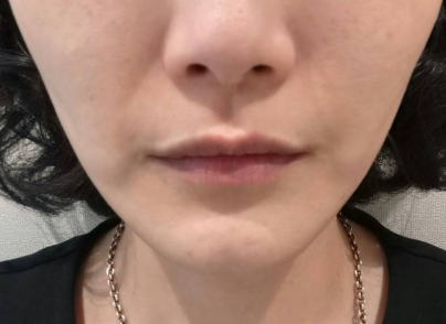 Case of Improving Nasolabial Folds and Sagging Deep Cheeks with Onda Lifting near Hongik Univ. Station image 1