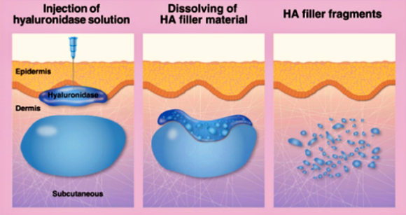 Hongdae Forehead Filler Effects: How Natural Is It, and How Long Does It Last? image 6
