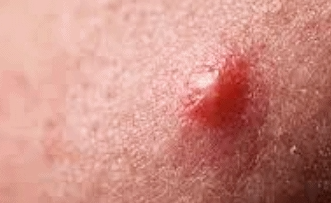 Hongdae Acne Extraction: 3 Things You Must Check image 3