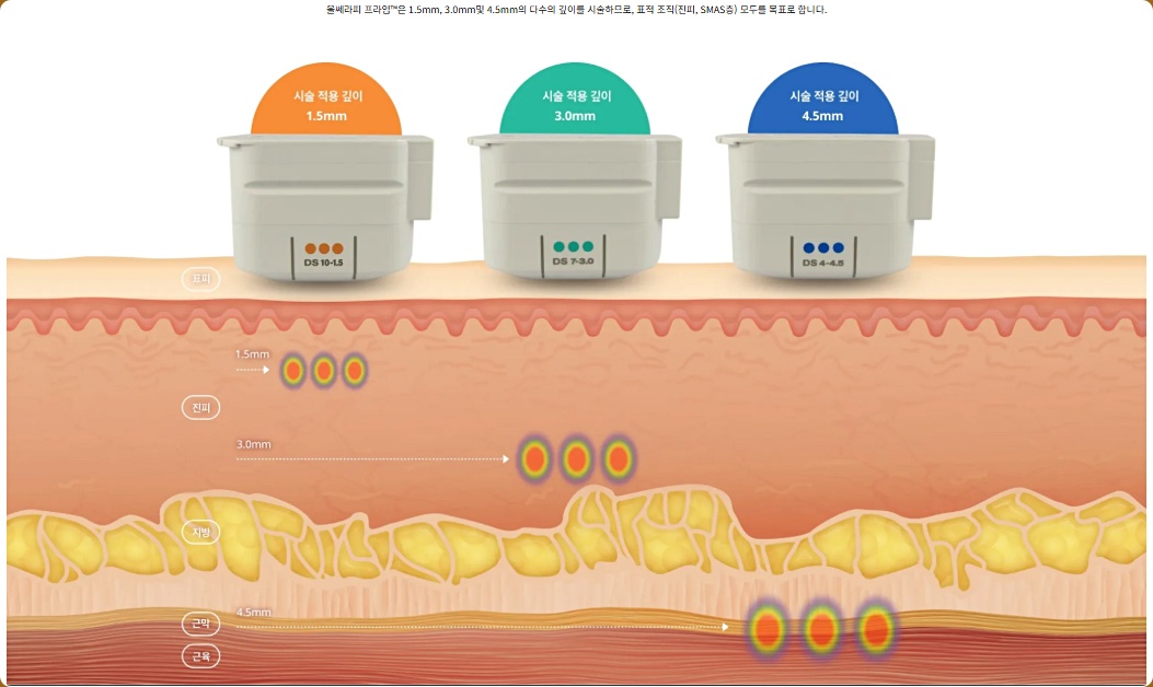 Sinchon Lifting: What Are the Jawline Improvement Effects of Ultherapy Prime? image 5