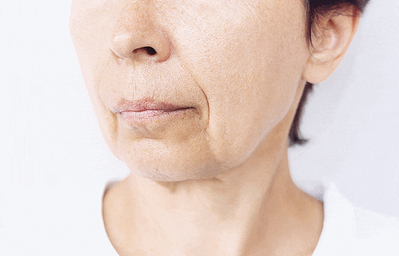 Hongdae Shurink Universe: How Is It Different from Existing Lifting Treatments? image 1