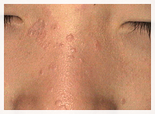 Shinchon Flat Warts May Spread If Simply Removed image 2