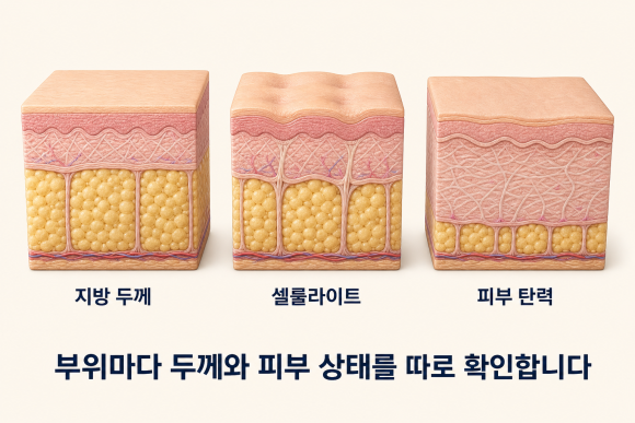 Can Sinchon Onda Body Lifting Also Help with Weight Loss? image 6
