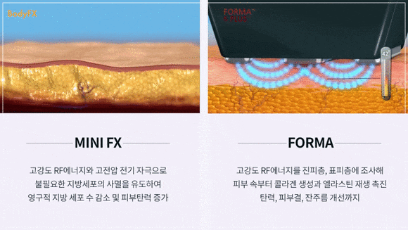 Is InMode in Hongdae Really Effective? Why It Varies from Person to Person image 6