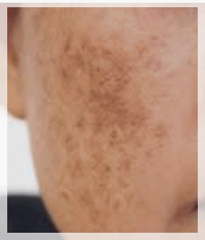 Sinchon Pico Toning: What to Check Before Considering Its Effects image 4