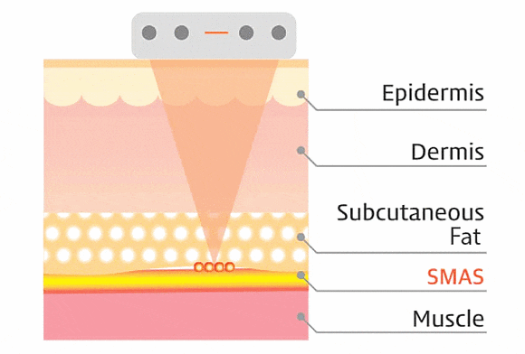 Hongdae Shurink Universe: How Is It Different from Existing Lifting Treatments? image 3