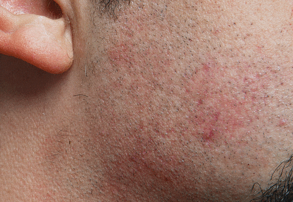 Check the Key Factors That Determine the Effectiveness of Sinchon Laser Hair Removal image 1