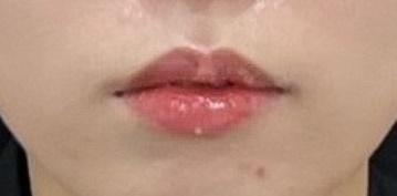 Hongdae Lip Filler: What Shape Is Right for My Lips? image 5