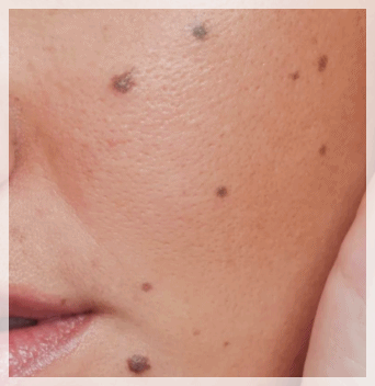 Hongdae Mole Removal: What to Know Before Having a Mole Removed image 1
