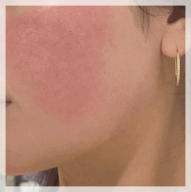 Hapjeong Station Dermatology Clinic: The Right Treatment for Your Skin Is Different for Everyone image 3
