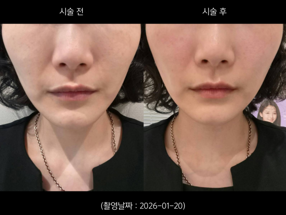Case of Improving Nasolabial Folds and Sagging Deep Cheeks with Onda Lifting near Hongik Univ. Station image 4