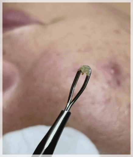 Sinchon Acne Dermatology Clinic, Why It Keeps Recurring Even After Treatment image 5