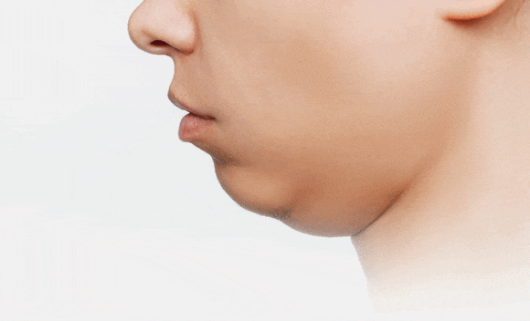 Considering Sinchon InMode or Ultherapy?! image 7