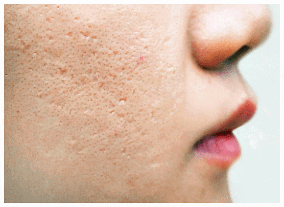 Hongdae Acne Dermatology Clinic: When Is the Right Time to Start Treating Acne Scars in Adolescents? image 2