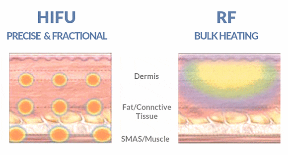 Hongdae Shurink Universe: How Is It Different from Existing Lifting Treatments? image 2
